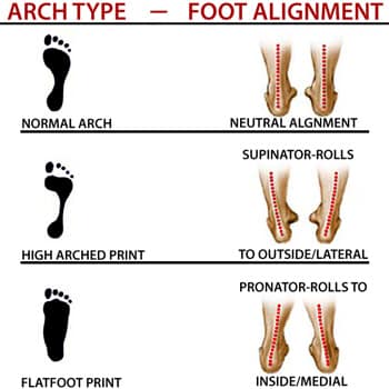 flat foot vs normal