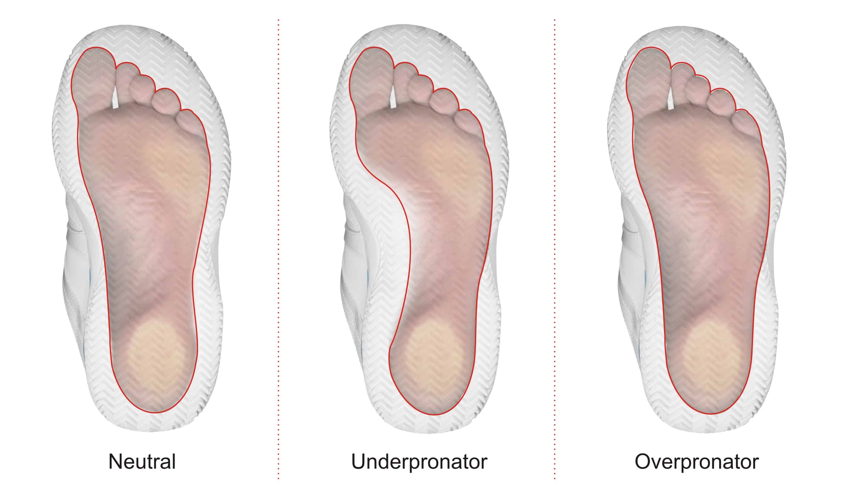 overpronation heel pain