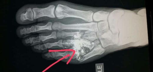 arthritc foot x-ray image
