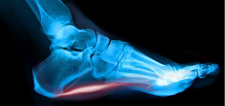 Running Shoes for Plantar Fasciitis 