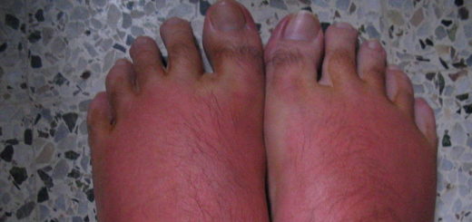 Burniing Feet