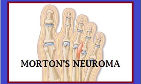Adidas Shoes for Morton's Neuroma
