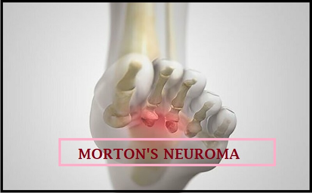 Clarks Shoes for Morton's Neuroma - Top Shoes Reviews